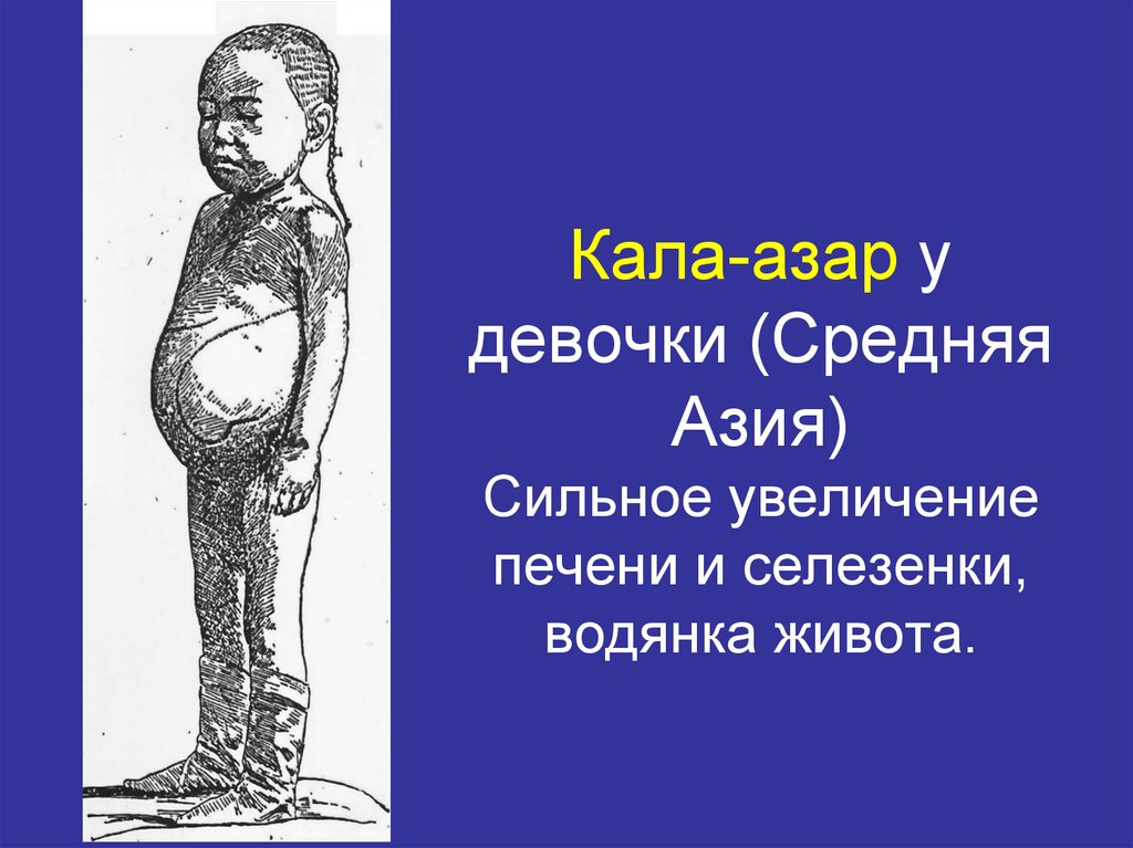 Кала-азар у девочки (Средняя Азия) Сильное увеличение печени и селезенки, водянка живота.