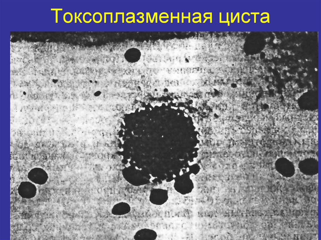 Токсоплазменная циста