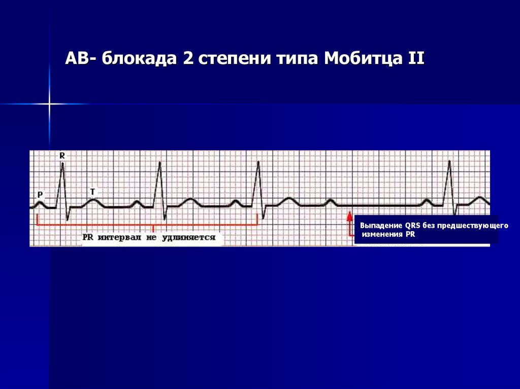 Ав блокада. АВ-блокады II степени, II типа Мобитца:. АВ блокада 1 Тип Мобитца. АВ блокада 2 степени 2 типа Мобитца. Av блокада 2 степени Тип Мобитца.