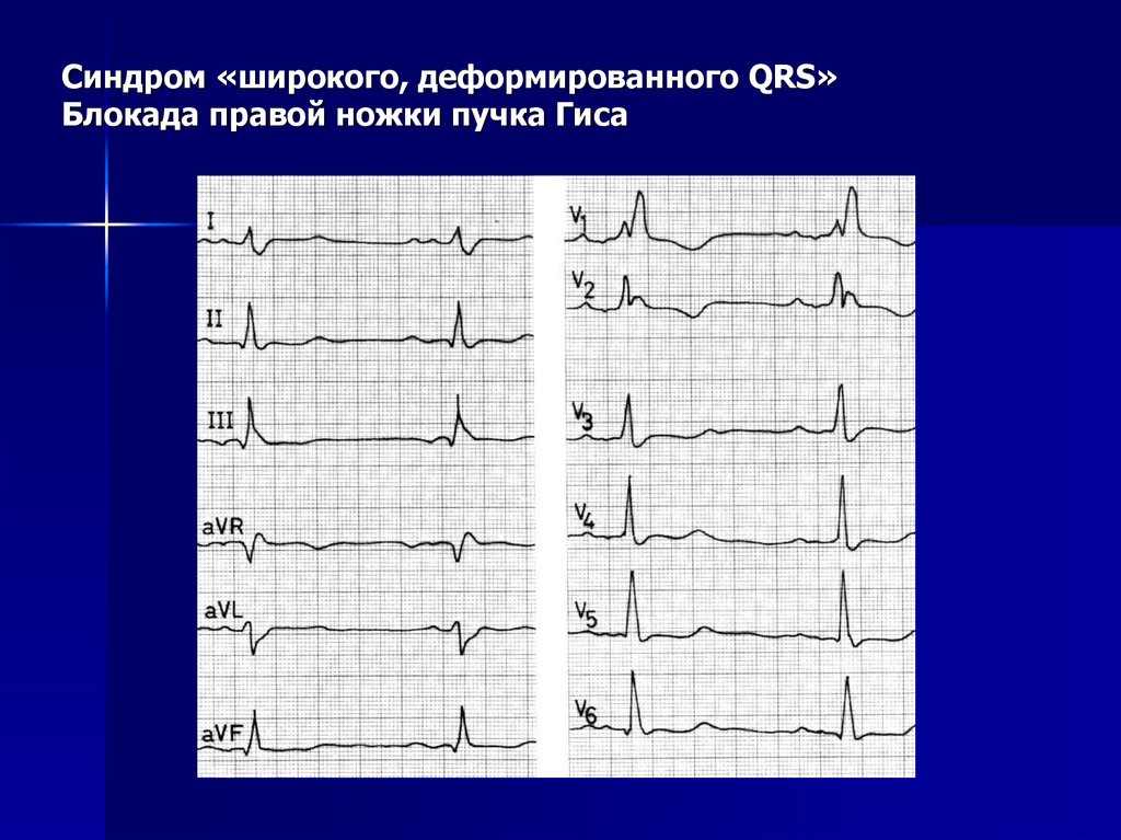 Qrs на экг что это. Блокада ПНПГ QRS. Блокада правой ножки пучка и wpw. Деформированный QRS на ЭКГ. М образный комплекс QRS блокада.