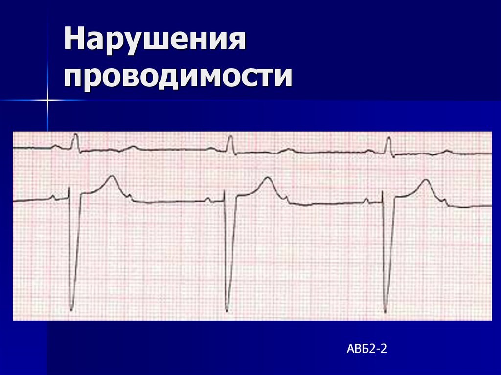 Экг нарушение проводимости. Нарушение проводимости на ЭКГ. Синдромы нарушений проводимости ЭКГ. Нарушения проводимости презентация. Нарушение проводимости у детей.