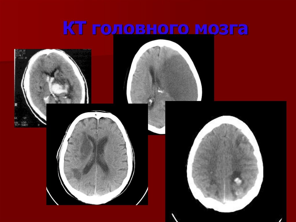 КТ головного мозга