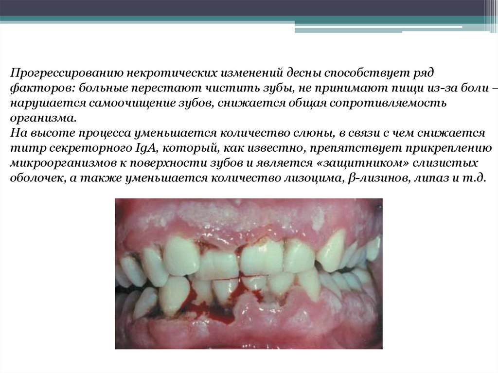 Язвенно некротический гингивостоматит фото