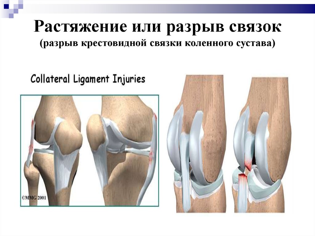 Показать разрыв. Микроразрыв связок коленного сустава. Перерастяжение связок коленного сустава. Растяжение надрыв связок колена. Растяжение связок коленного сустава тейпирование.