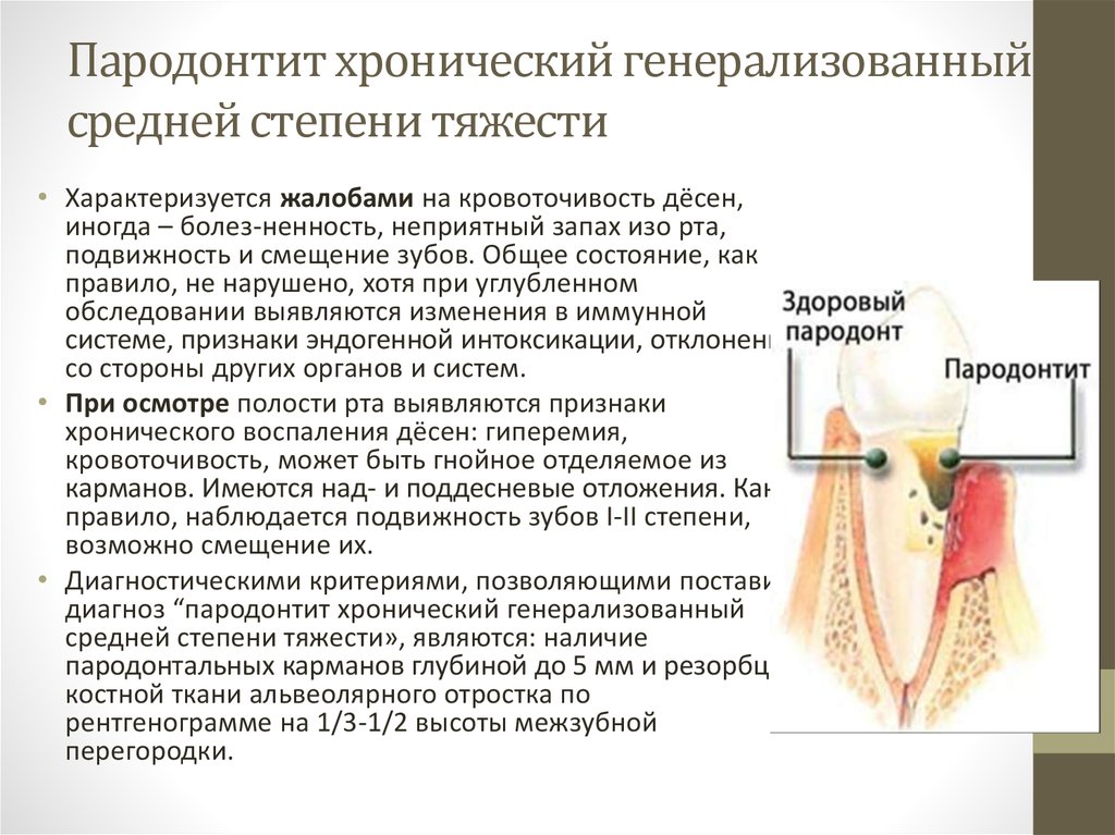 Мкб после удаления зуба. Пародонтит средней степени тяжести клиника. Лечение генерализованного пародонтита легкой степени тяжести. Степени тяжести пародонтита классификация. Классификация хронического пародонтита по степеням тяжести.