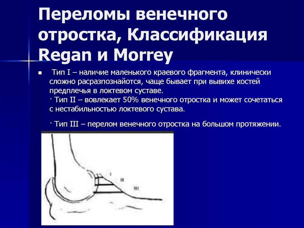 Переломы венечного отростка, Классификация Regan и Morrey 