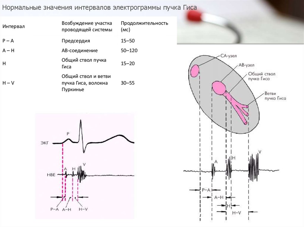 Эфи. Электрофизиологическое исследование сердца нормы. Эфи ЭКГ. Внутрисердечное электрофизиологическое исследование сердца. Электро функциональное исследование сердца.