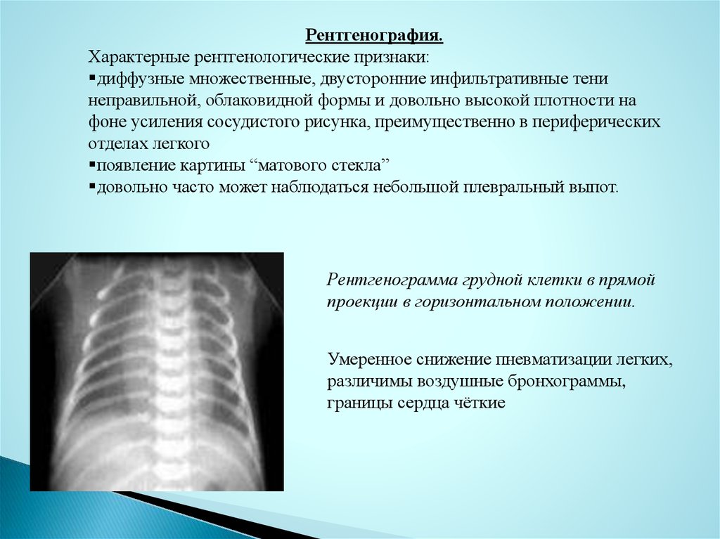 Пневматизация кишечника что это такое