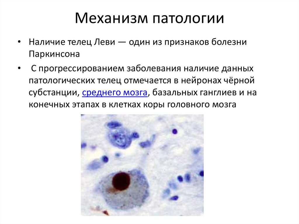 Патология болезнь. Тельца Леви. Тельца Леви в черной субстанции. Болезнь с тельцами Леви.