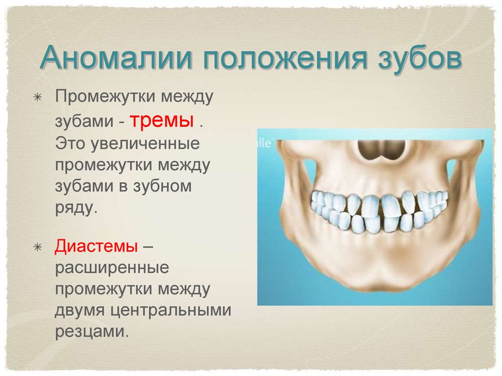 Почему зубы отличаются между собой у разных. Аномаии положениязубов. Аномалии положения зубов. Аномальное расположение зубов. Неправильное расположение зубов.