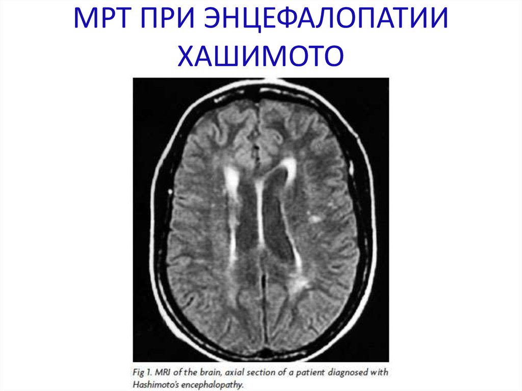 Резидуальные очаги головного мозга. Энцефалит головного мозга кт. Энцефалопатия головного мозга на кт. Дисциркуляторная энцефалопатия на кт. Резидуальная энцефалопатия кт.