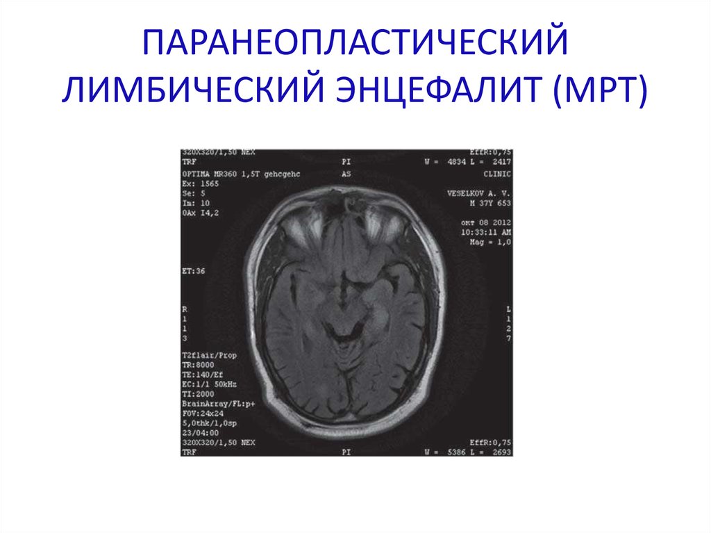 Энцефалит мрт картина