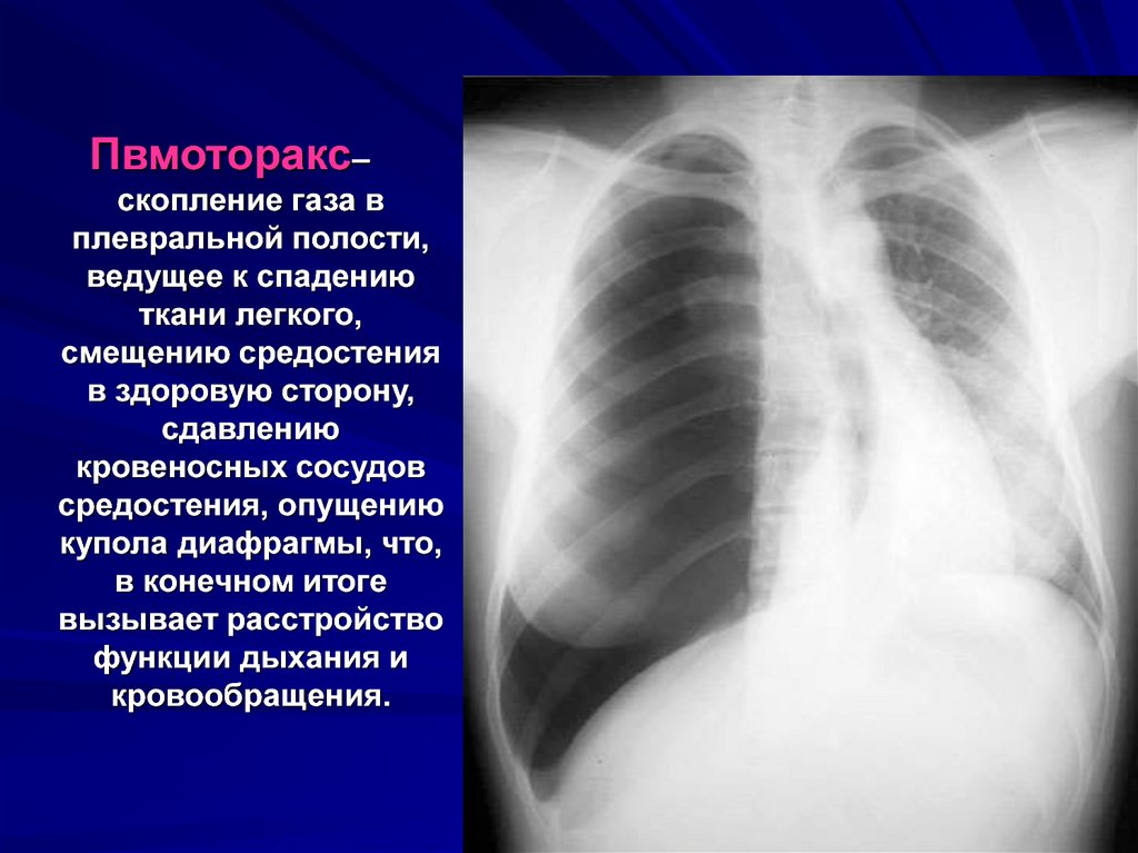 Рентген картина пневмоторакса