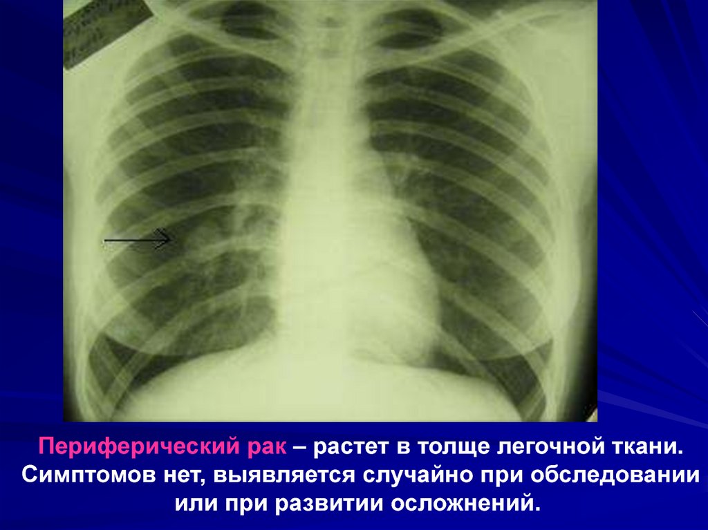 14 легких. Метастазы в лёгких на флюорографии. Объемное новообразование правого легкого что это такое. Новообразование в правом легком 3 см.