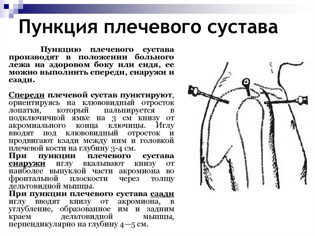 Пункция плечевого сустава. Точки пункции плечевого сустава топографическая анатомия. Пункция плечевого сустава точки пункции. Боковая пункция плечевого сустава. Пункция плечевого сустава техника выполнения.