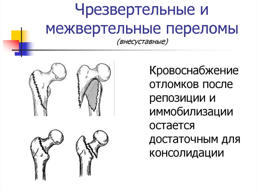 Открытый перелом бедренной кости карта вызова