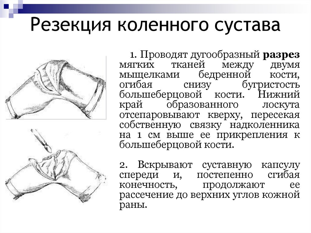 Операции на костях. Внекапсулярная резекция сустава. Резекция коленного сустава по Корневу. Внутрикапсульная резекция сустава. Резекция сустава по Текстору.