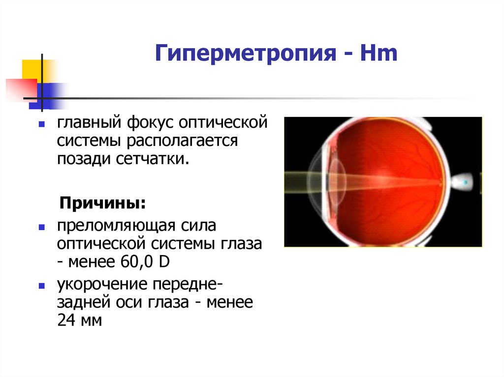 Рефракция глаза презентация