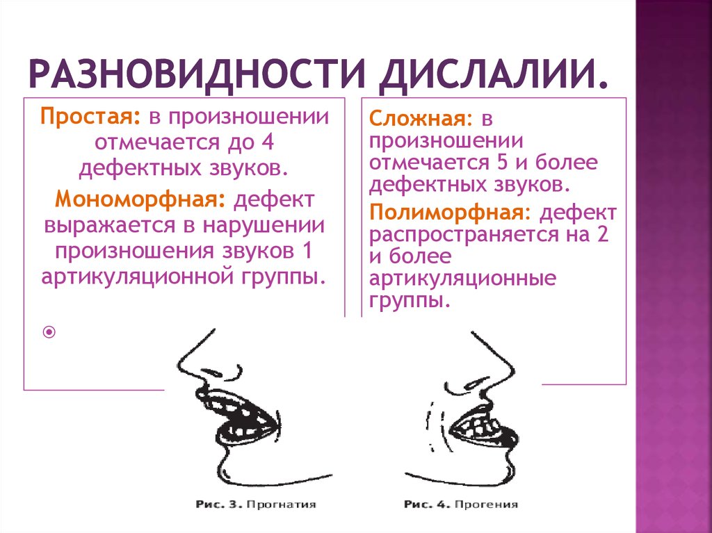 Простая дислалия. Классификация дислалии схема. Нарушения звуков при дислалии. Симптомы механической дислалии. Виды дислалии у детей.