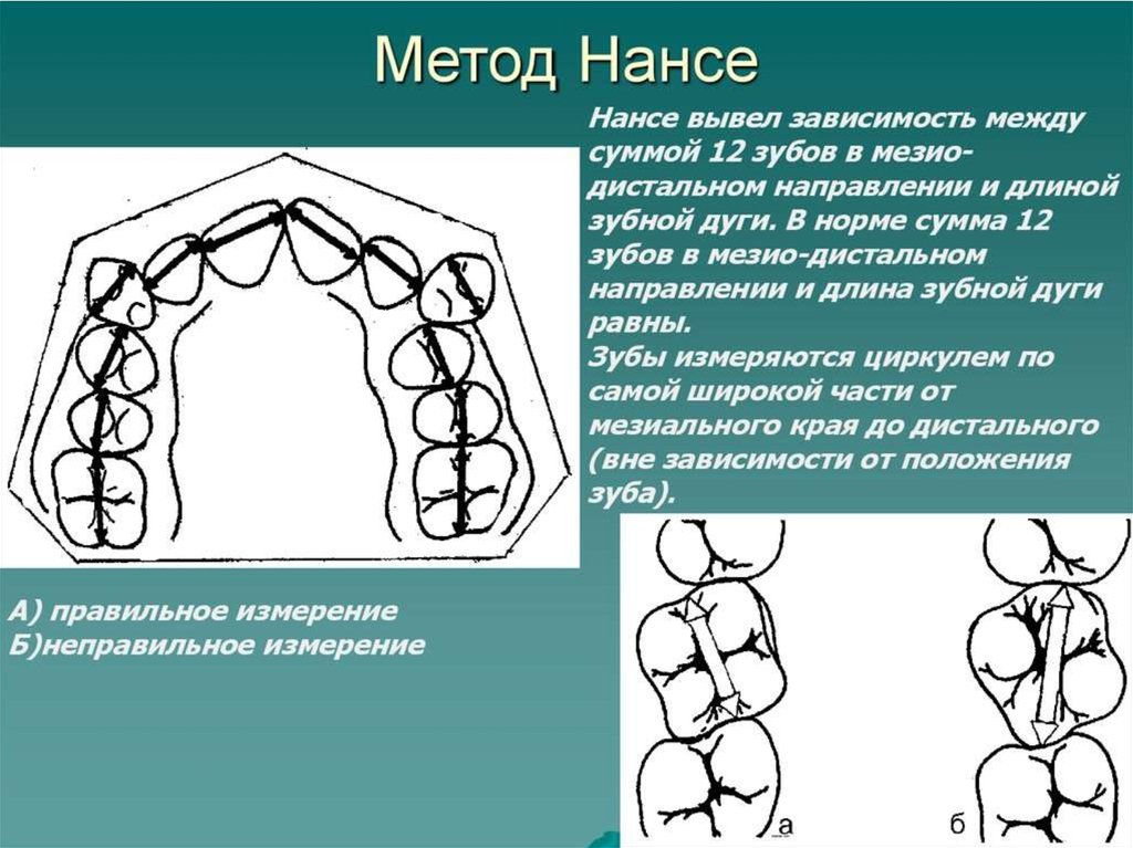 Анализ моделей челюстей. Апикальный базис метод снагиной. Тон ортодонтия. Измерение гипсовых моделей челюстей в ортодонтии. Тон ортодонтия.