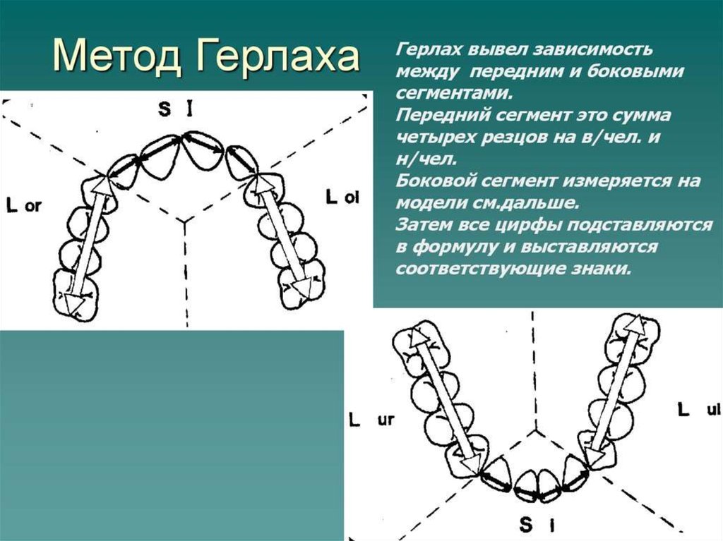 Индекс болтона. Метод Герлаха. Метод Герлаха в ортодонтии. Ортодонтия метрд героаза. Методы измерения зубных рядов.