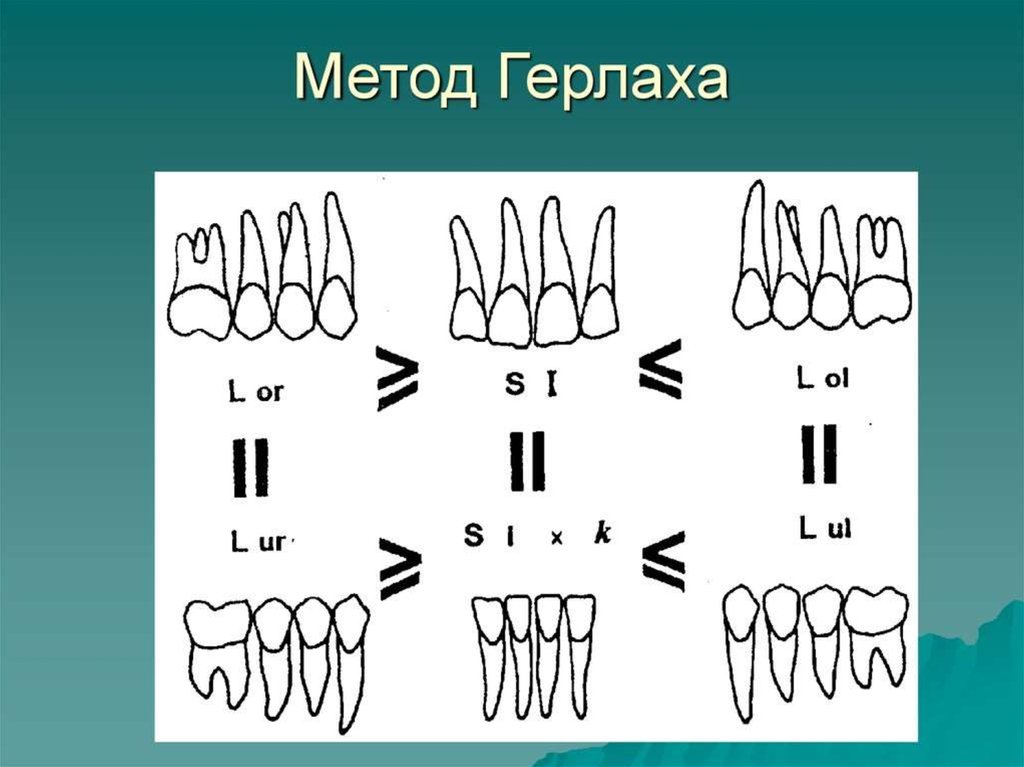 Индекс пона. Метод Герлаха. Метод Герлаха в ортодонтии. Формула Герлаха. Ортодонтия метрд героаза.