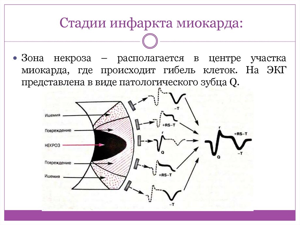 Прединфарктный