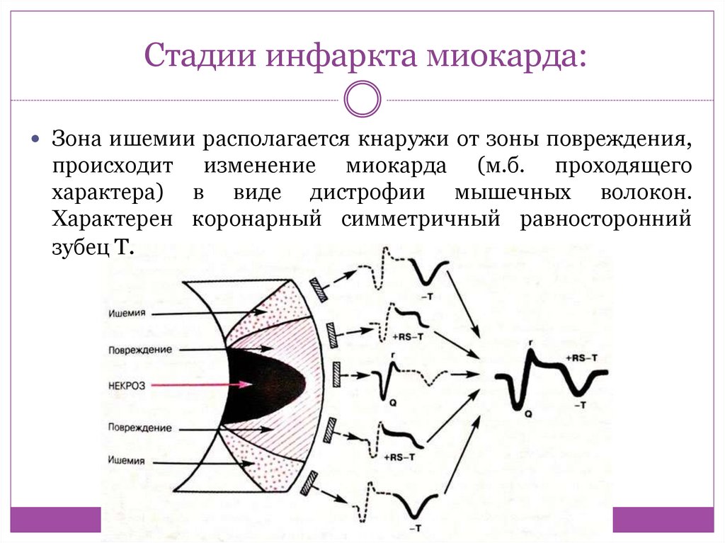 Прединфарктный