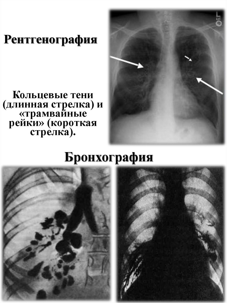 Болезнь рентген