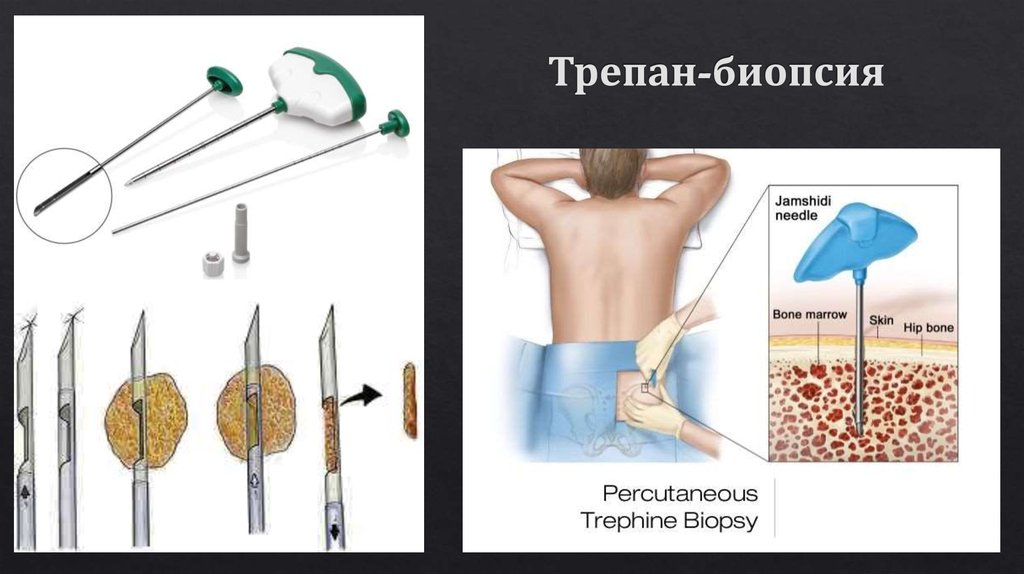 Трепан-биопсия