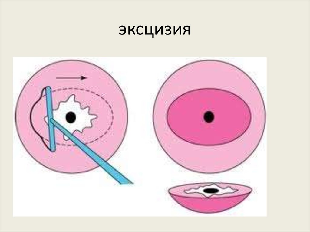 Конизация гистология. Петлевая эксцизия шейки. Петлевая электроконизация шейки матки. Петлевая конизация шейки матки. Хирургическая конизация шейки матки.