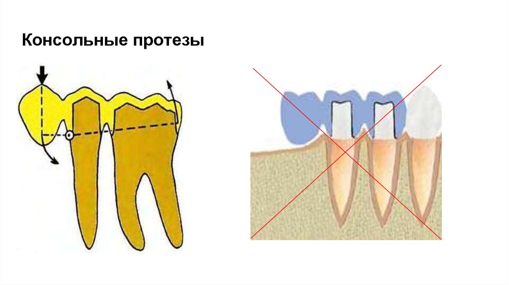 Консольный протез. Консольные мостовидные протезы показания. Мостовидные протезы с односторонней опорой. Консольный мостовидный протез с одним опорным зубом. Консольный протез с опорой на два зуба.