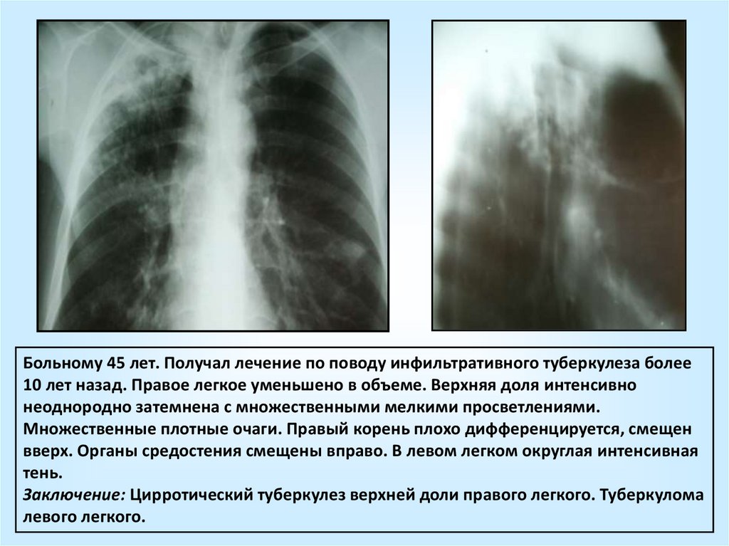 Кавернозная форма туберкулеза