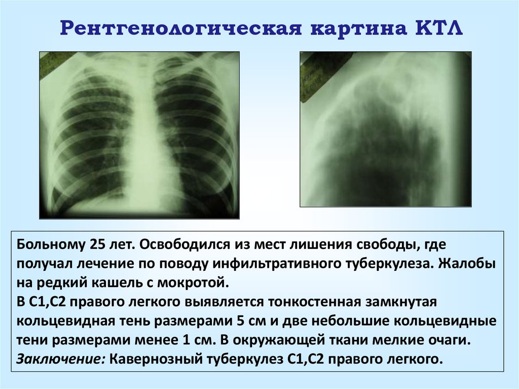 Цирротический туберкулез легких рисунок