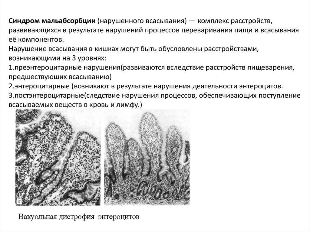 Нарушение моторной функции кишечника