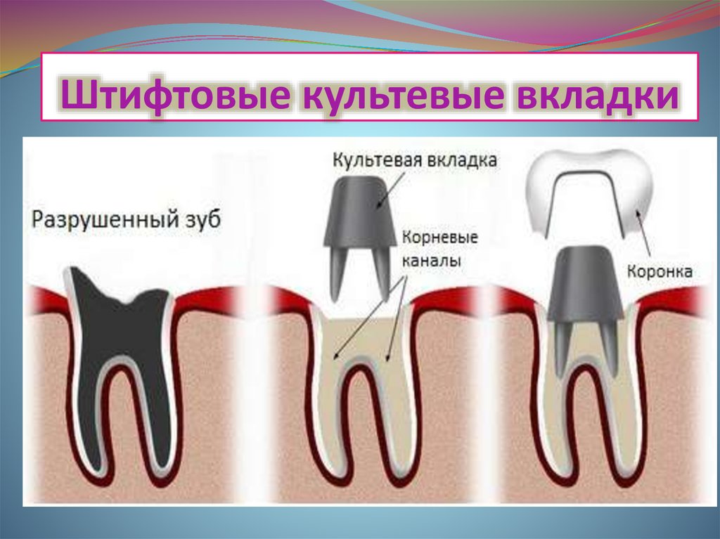 Коронка ходит на зубе. Культевая вкладка штифт зуб. Штифтово культевая конструкция.