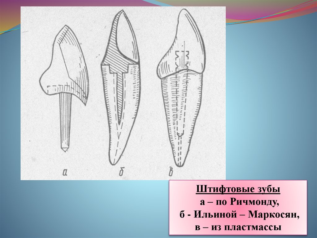 Штифтовый зуб по ричмонду. Штифтовой зуб по Ильиной-Маркосян. Коронка Ильиной Маркосян. Штифтовые зубы по н.а Пучко. Штифтовые зубы по Ричмонду Ильиной-Маркосян Ахмедову.