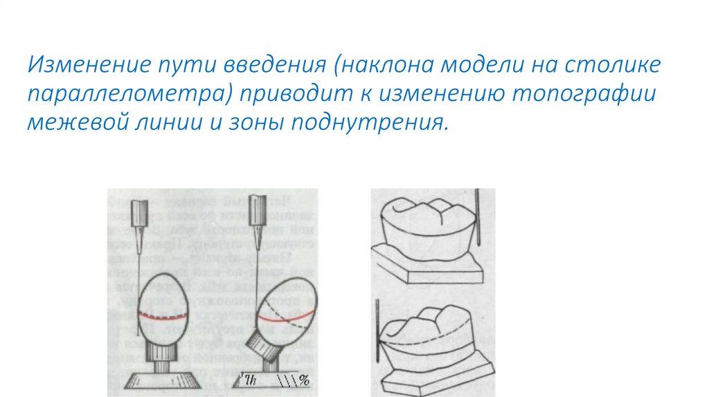 Параллелометрия в ортопедической стоматологии