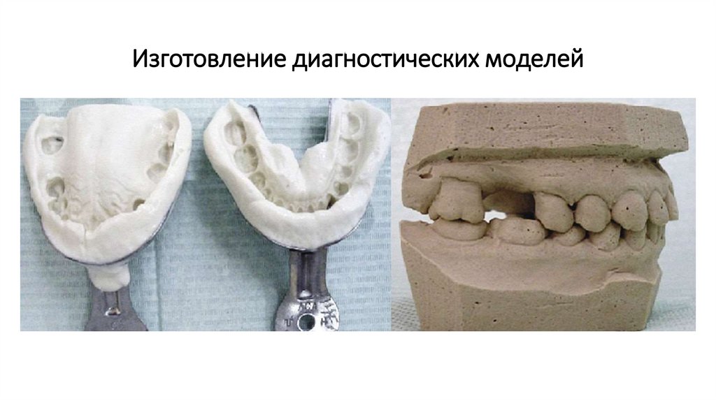 Изготовление гипсовой модели. Параллелометрия бюгельного протеза. Отливка диагностических моделей. Диагностическая модель и слепок. Гипсовая модель зубов.
