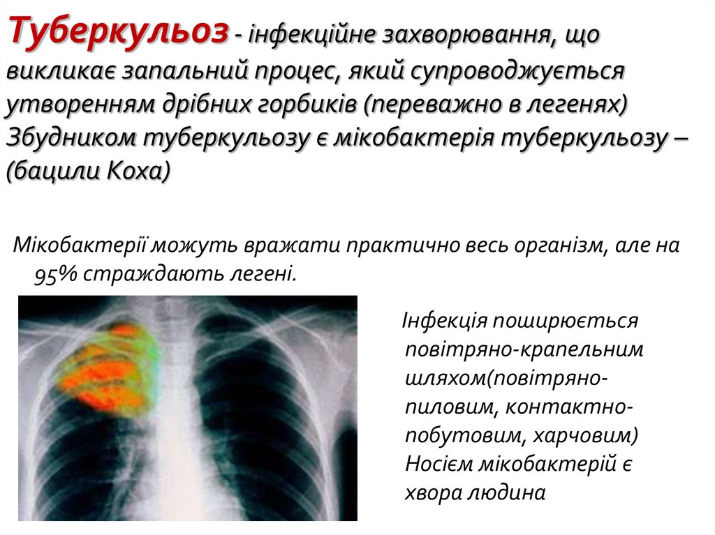 Туберкульоз - інфекційне захворювання, що викликає запальний процес, який супроводжується утворенням дрібних горбиків
