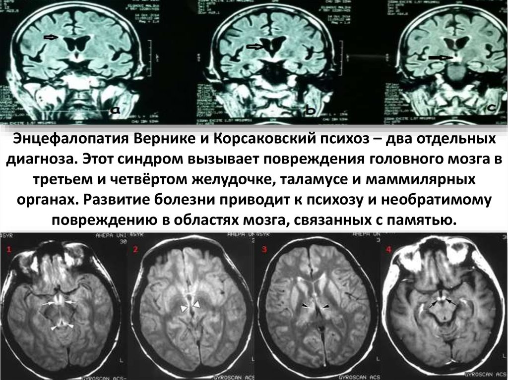 Энцефалопатия головного мозга последствия. Энцефалопатия Вернике Корсакова. Энцефалопатия Вернике. Синдром Вернике-Корсакова. Энцефалопатия Вернике мрт картина.