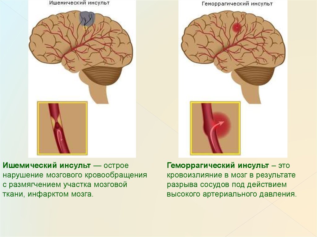 Что такое ишемический инсульт головного мозга. Ишемический инсульт схема. Геморрагический и ишемический инсульты схема. Типы ишемического инсульта. Инсульт и ишемический инсульт.