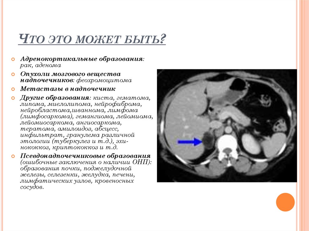 Туберкулез надпочечников. Миелолипома надпочечника кт. Инциденталомы надпочечников. Миелолипома селезенки.