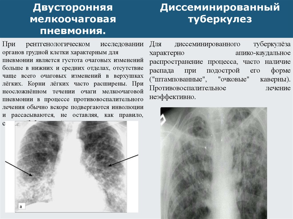 Диссеминированный туберкулез легких картинки