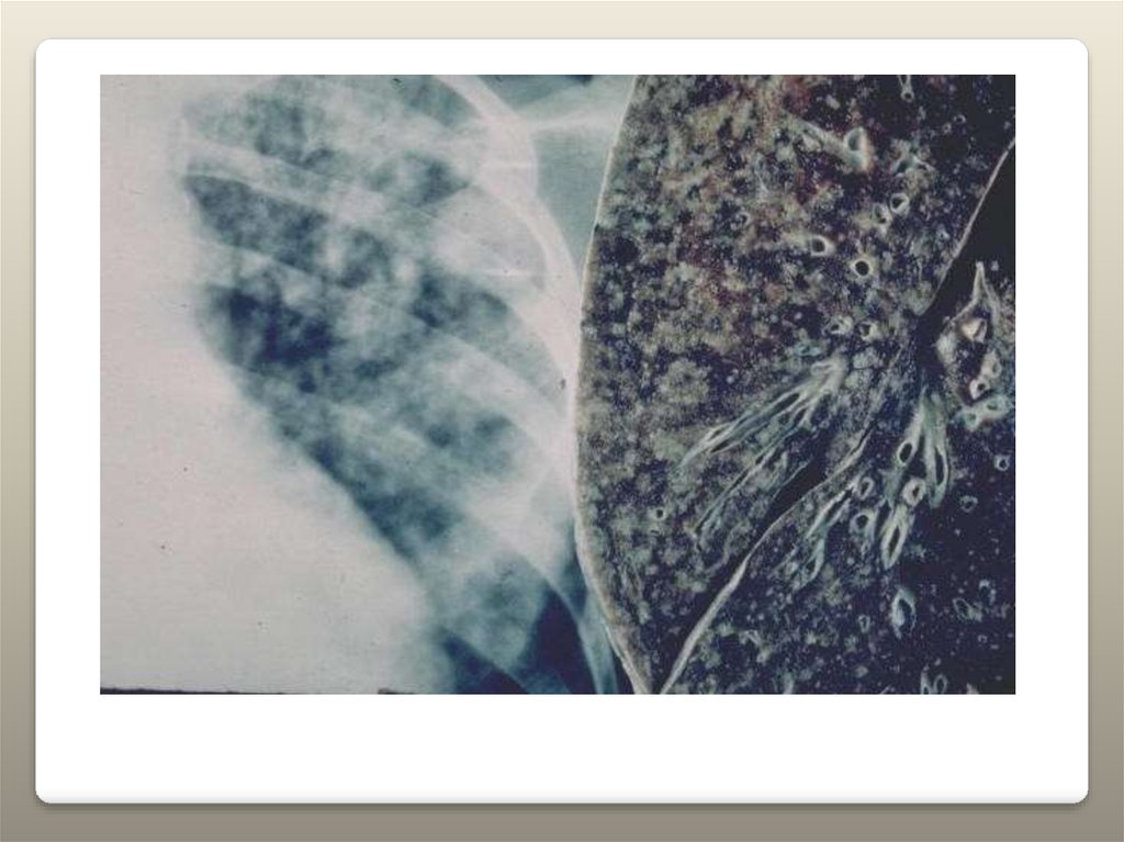 Поражаемые органы туберкулеза. Диссеминированный туберкулез макропрепарат. Макропрепарат подострый диссеминированный туберкулёз. Диссеминированный пневмония. Милиарный диссеминированный туберкулез кожи.