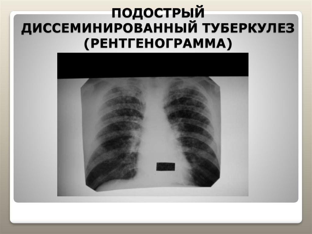 Диссеминированный туберкулез фаза инфильтрации. Лимфогенно диссеминированный туберкулез рентген. Диссеминированный туберкулез на кт. Диссеминированный туберкулез на рентгенограмме. Подострый диссеминированный туберкулез рентген.
