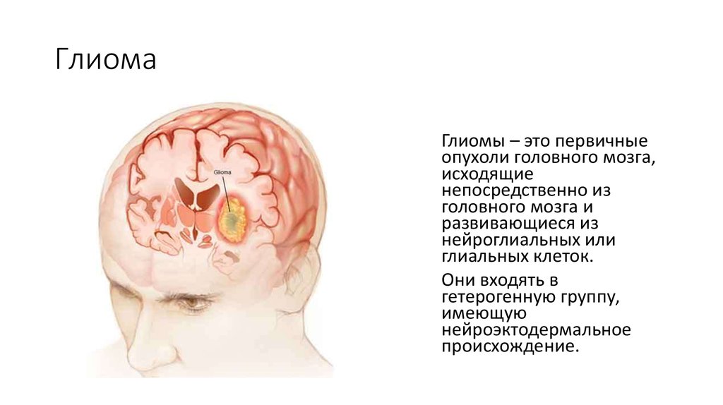 Опухоль головного мозга это. Глиома опухоль головного мозга симптомы. Глиобластома лобной доли. Опухоль мозга глиобластома. Глиоматоз головного мозга Продолжительность жизни.