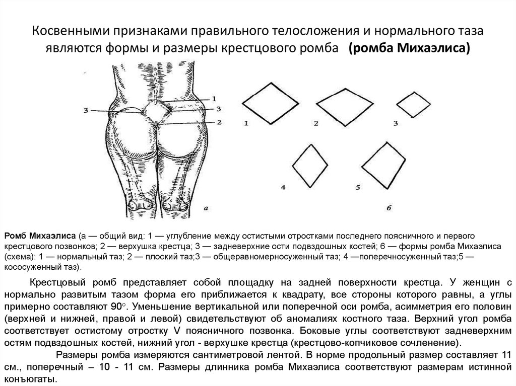 Норма таза у женщин. Пояснично крестцовый ромб Михаэлиса норма. Измерение ромба Михаэлиса. Измерение и оценка крестцового ромба Михаэлиса. Измерение ромба Михаэлиса норма.