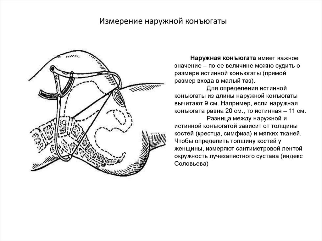 Конъюгат. Конъюгаты таза Акушерство. Диагональная конъюгата в акушерстве. Наружная конъюгата в норме равна. Методика измерения наружной конъюгаты.