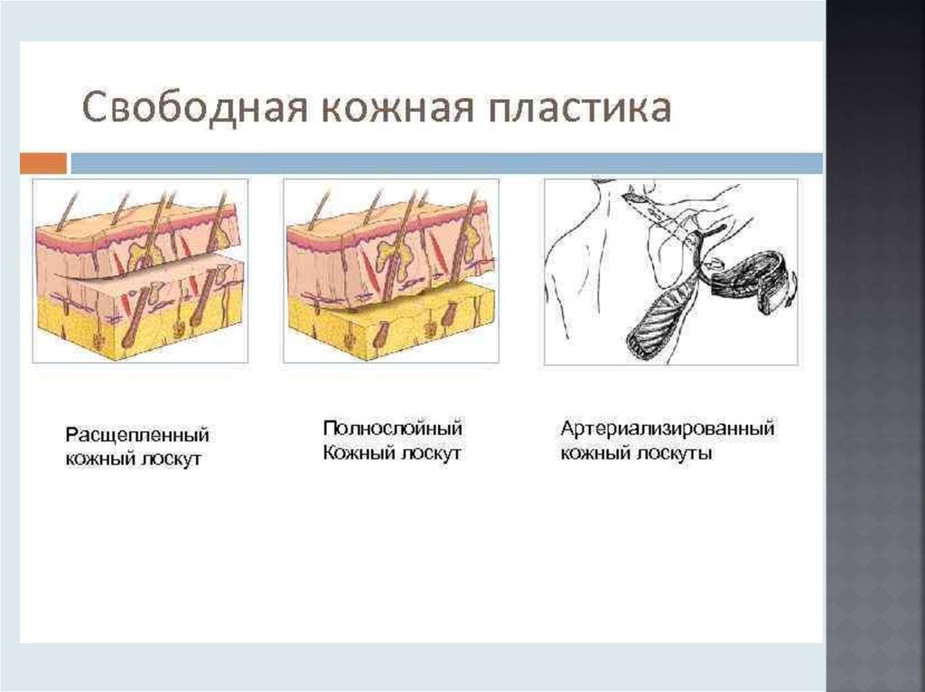 Местная пластика. Полнослойный кожный лоскут. Кожная пластика расщепленным кожным лоскутом. Свободный расщепленный кожный лоскут. Свободная кожная пластика расщепленным лоскутом это.